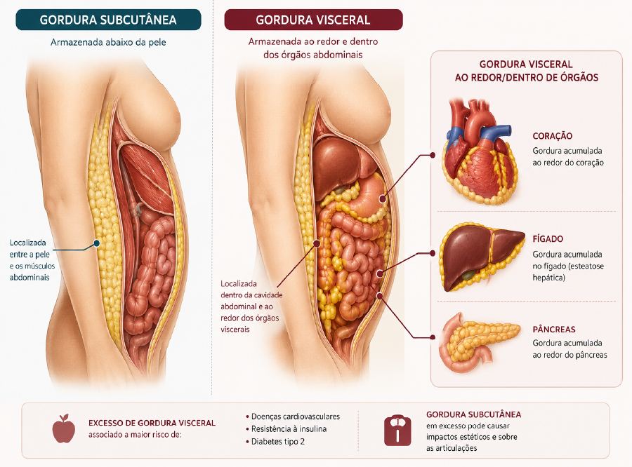 Ilustração da gordura visceral acumulada ao redor dos órgãos abdominais, em contraste com a gordura subcutânea